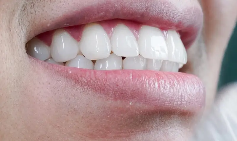 Reabilitação oral e estética dental: entenda os benefícios dos tratamentos que transformam saúde e autoestima